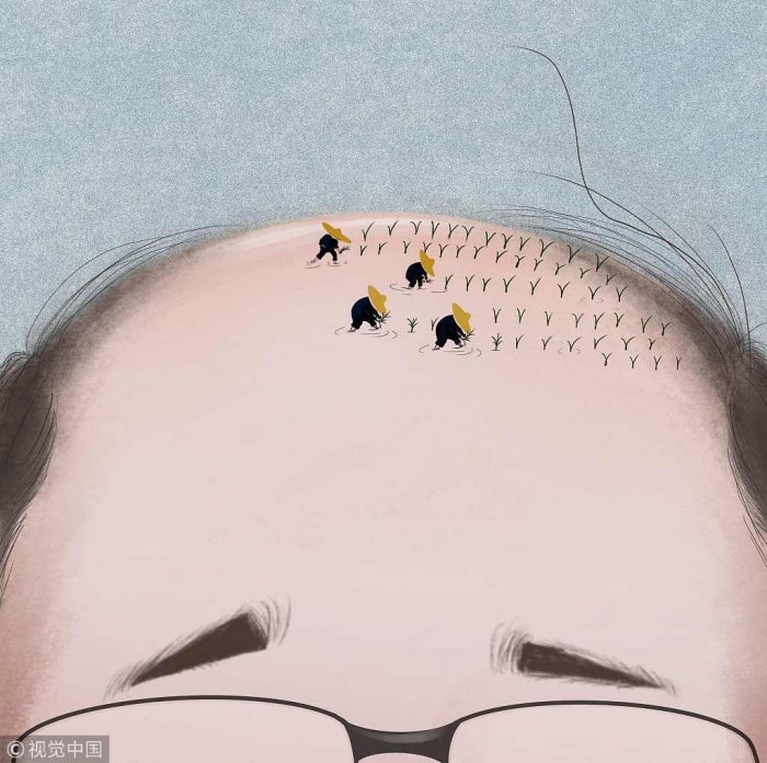 Все больше китайцев теряют волосы на голове из-за стрессов и экологии