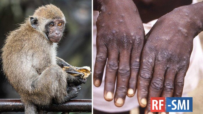 FT: ученые объяснили вспышку оспы обезьяны в мире повышенной мутацией вируса
