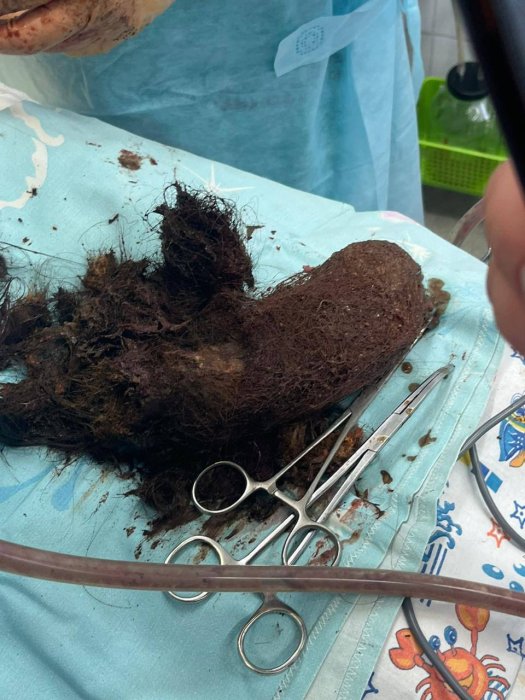 Сургутские хирурги достали из желудка девочки громадный клубок волос